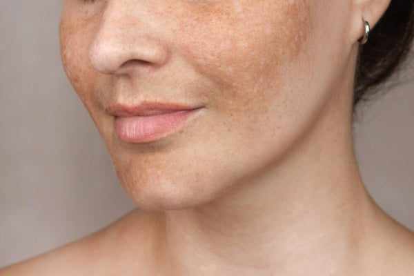 Dark spots and uneven tone